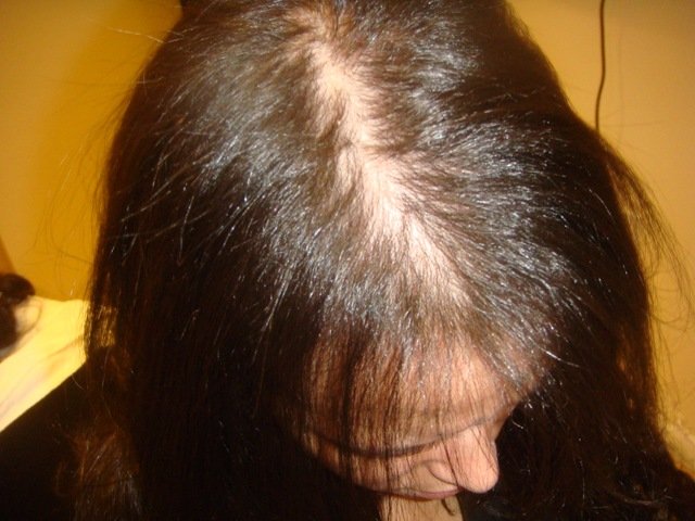Волосы После Химиотерапии Через Год Фото